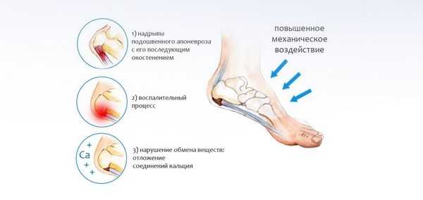 Подошвенный фасциит